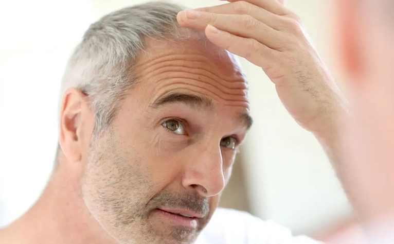 Hair_Transplant london