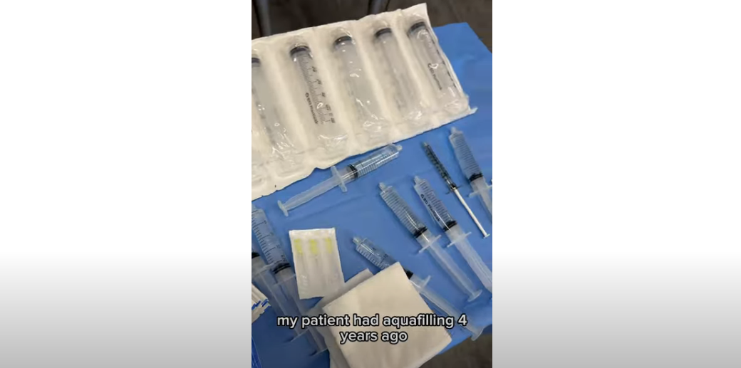 Filler Removal from Another Clinic! #drducu #fillerremoval #nonsurgical #london