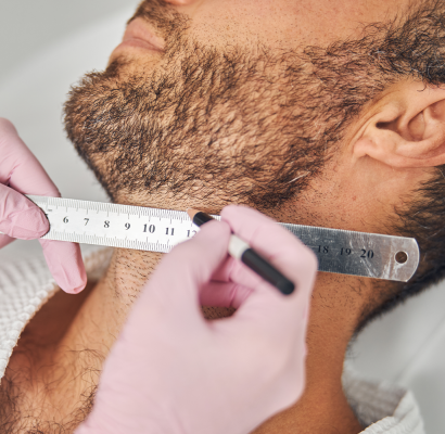 2_Beard_Transplant