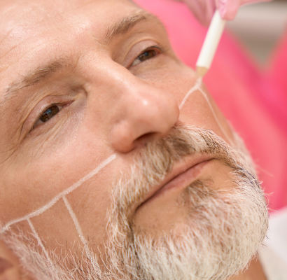 3_Beard_Transplant