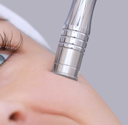 3_Microdermabrasion