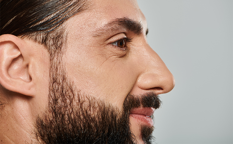 5_Beard_Transplant