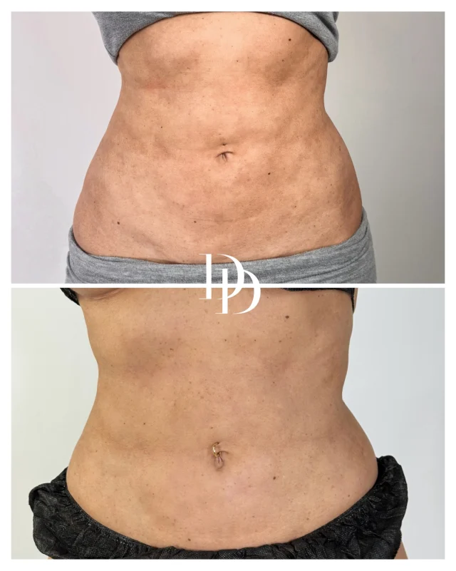 injection de glutathion avant et après Glutathion : Éclaircir et Unifier la Peau Naturellement – Rayonne  Procosmetics main image 0